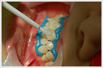 6）調整した薬剤を歯面に塗布していきます。